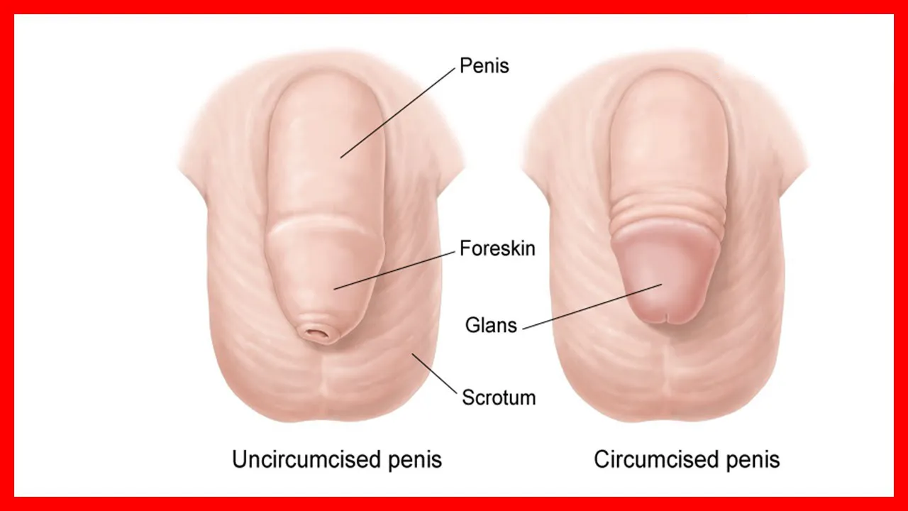 Adult Circumcision